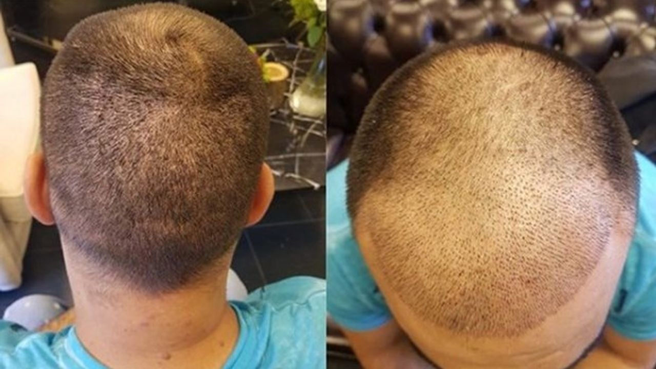 Saç ekimi ölüme götürdü... Doktor: Tansiyonun düşmüştür'