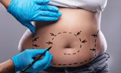 Uzmanından "liposuction" hakkında doğru bilinen yanlışlar