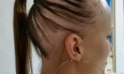 Göğüs büyütme ameliyatından sonra kel kaldı