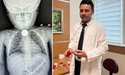 Yutkunamama şikayetiyle hastaneye gitti... Yemek borusundan et çıktı