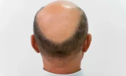 3 haftada saç çıkaran 'mucize serum' geliştirildi