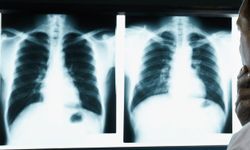 Uzmanından Akciğer kanserinde erken teşhis uyarısı!