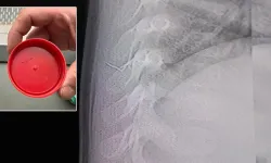 Bebeğin akciğerinden çıkan cisim şaşırttı!