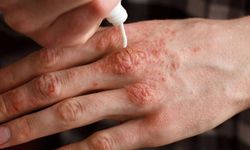 Ciltte kaşıntı ve kızarıklığa dikkat: Egzama belirtileri neler?
