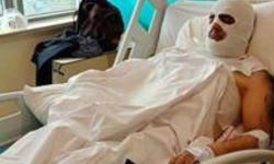 Ölümden dönen işçinin sağ koluna deri nakledildi