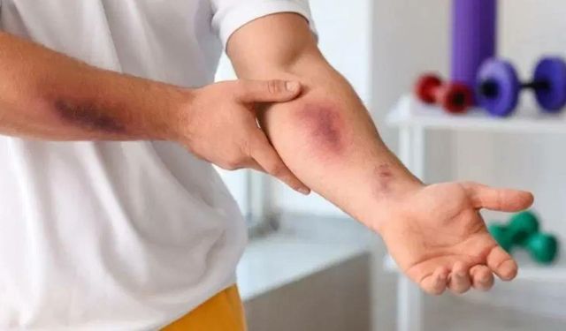 Uzmanı uyardı: Geçmeyen morarma ve kanamalara dikkat!