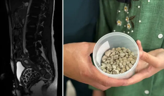 Doktorlar bile şok oldu: Vücudundan 287 tane taş çıkarıldı!