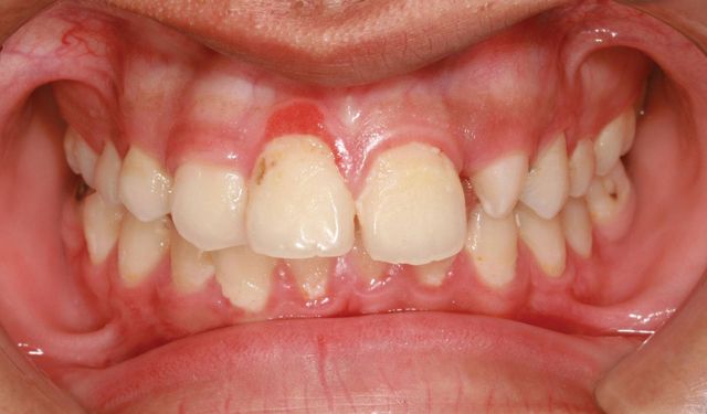 'Türkiye'de her iki yetişkinden biri diş eti hastalığıyla karşı karşıya'