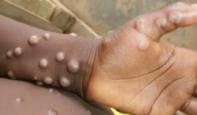 'Maymun çiçeği' alarmı... Vaka sayısı 583’e yükseldi!