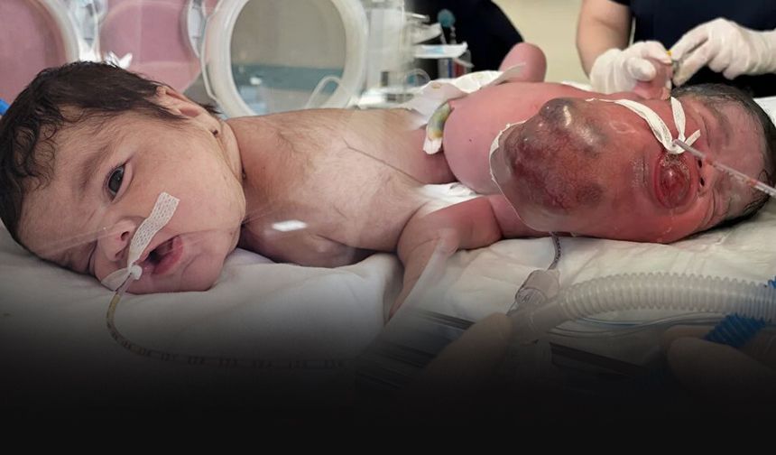 34 haftalık minik Eymen dünyada yedinci vaka! Boynundan 445 gram tümör çıkarıldı