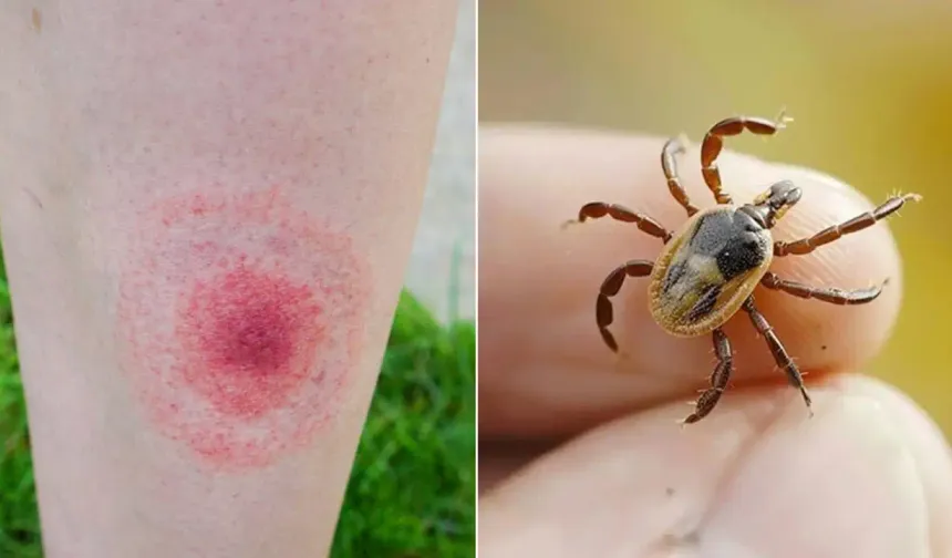 Keneler lyme hastalığına sebep oluyor!