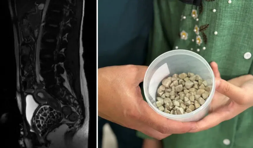 Doktorlar bile şok oldu: Vücudundan 287 tane taş çıkarıldı!