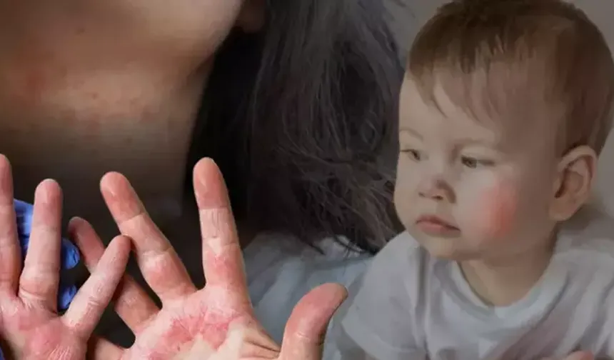 Türkiye de listede... 'Sıradan alerji' değil: 'Kaşıdıkça çoğalır'