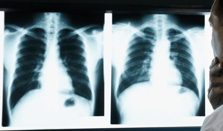 Uzmanından Akciğer kanserinde erken teşhis uyarısı!