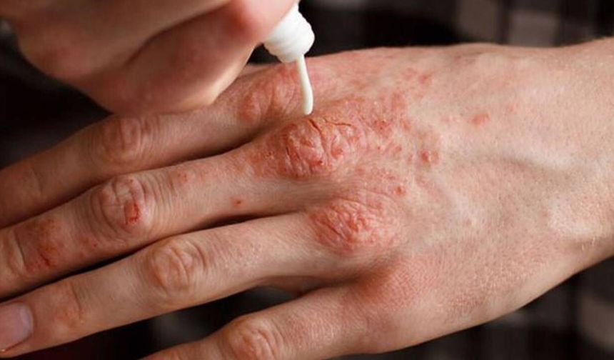 Ciltte kaşıntı ve kızarıklığa dikkat: Egzama belirtileri neler?