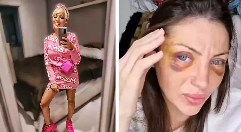 Barbieye Benzemek Icin 27 Kez Ameliyat Olmustu Fenomenin Gizemli Olumu 2